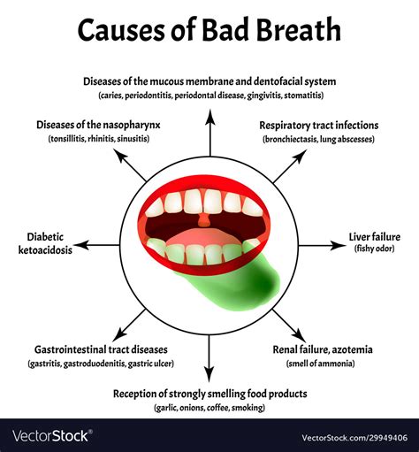 Causes bad breath halitosis the structure of Vector Image