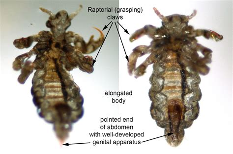 Pathology Outlines - Pediculosis (lice)