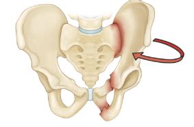 Broken Pelvis | Fractured Pelvis Treatment & Recovery | ROC