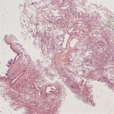 A. Overview with patchy peribronchial broadening of alveolar septa and... | Download Scientific ...