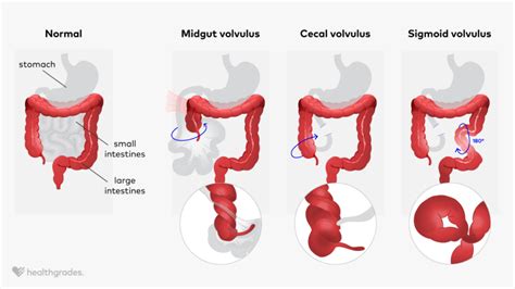 Volvulus: Definition, Causes, and Treatment