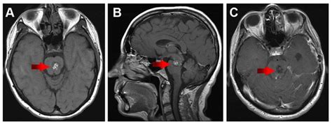 Cavernous Malformation Symptoms | Stanford Health Care