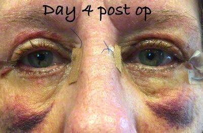 Recovery After Eyelid Surgery » Eyelid Surgery: Cost, Photos, Rewiews, Q&A