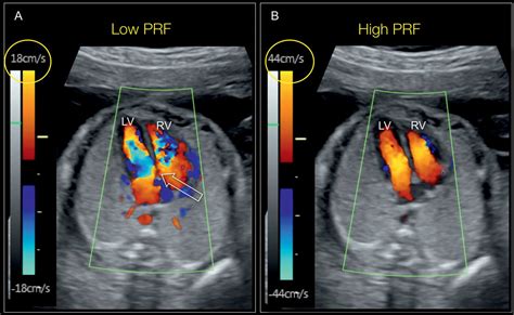 Color Doppler in Fetal Echocardiography | Obgyn Key