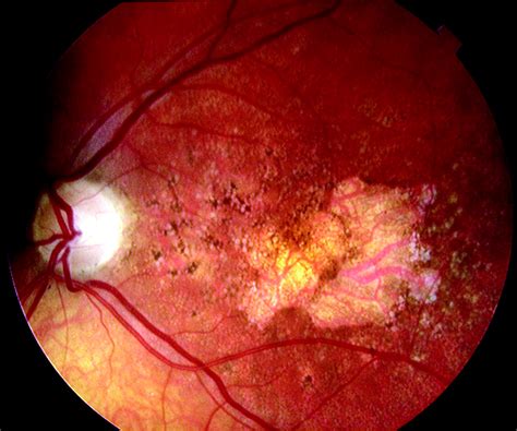 Age related macular degeneration | The BMJ