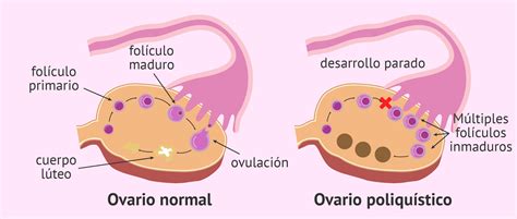 Ovario normal vs. ovario poliquístico