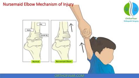 Nursemaid Elbow | OrthoFixar 2024