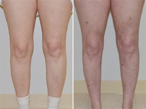 granzow_lymphedemalipedemacenter_beforeandafter_featured__0018_lipisuction_jennifer2 ...