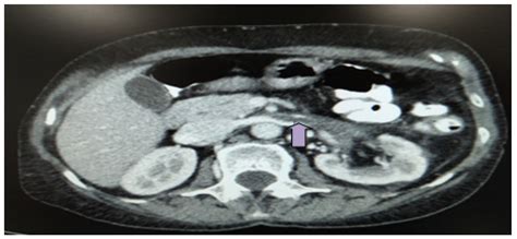 Life | Free Full-Text | Acute Renal Vein Thrombosis Following COVID-19 ...