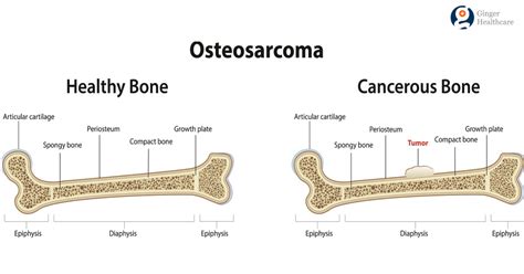 Bone Cancer: Symptoms, Causes, Diagnosis, Types & Treatment options