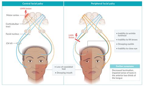 Facial Nerve Palsy Upper Motor Neuron