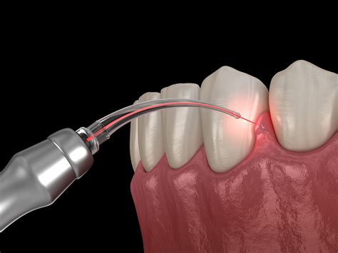 Laser Sulcular Debridement - Campbell, CA: Ueno Center Dental Specialists