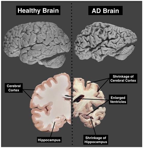 A Close Look into the Alzheimer’s Brain | Alzheimers, Brain, Alzheimer ...