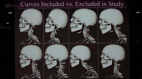 Reversal Of Cervical Lordosis Treatment - Quotes Update Viral