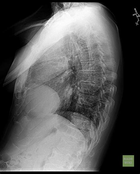 Pericardial cyst - wikidoc