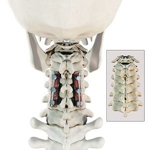 Posterior Cervical Fusion Surgery Oklahoma City, OK | Cervical ...