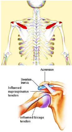 Supraspinatus Tendinitis