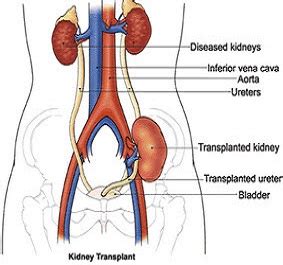 About Kidney Transplant Surgery | Stony Brook Medicine