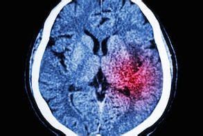 Athetoid Cerebral Palsy - Causes, Symptoms and Treatment