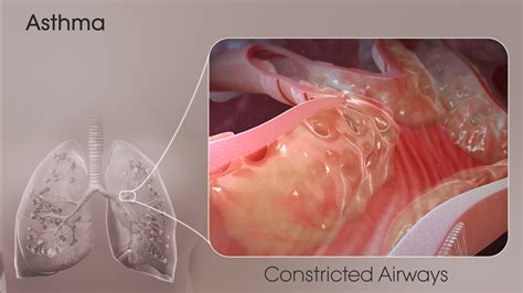 Important things to know about Asthma - Scientific Animations