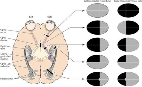 Hemianopsia; Hemianopsia, Binasal; Hemianopsia, Bitemporal; Hemianopsia, Homonymous; Quadrantanopsia