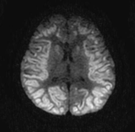 Anoxic brain injury | Radiology Reference Article | Radiopaedia.org