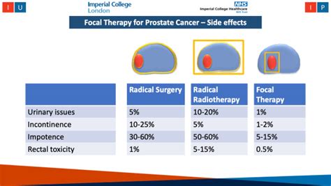 HIFU for Prostate Cancer Treatment | Prof. Hashim Ahmed