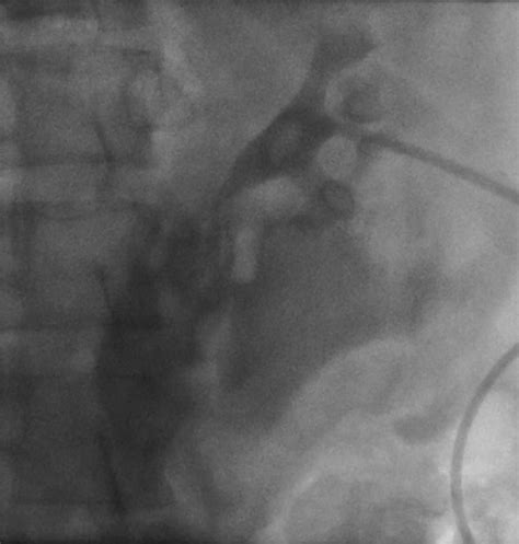 Left retrograde cystoscopy exhibiting extravasation of contrast ...