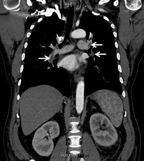 Renal vein thrombosis and pulmonary embolism | Cleveland Clinic Journal ...