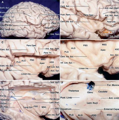 Insula and Sylvian Fissure | The Neurosurgical Atlas, by Aaron Cohen-Gadol, M.D.