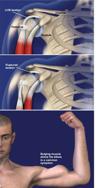 Biceps Tendon Rupture: prescott az orthopedic surgeon - DAVIS ORTHOPAEDICS