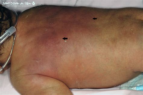 Subcutaneous Fat Necrosis of the Newborn: Report of Five Cases ...