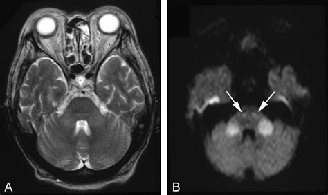 Cerebral Peduncle Mri