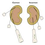 Performing Renal Biopsy | Clinician's Brief