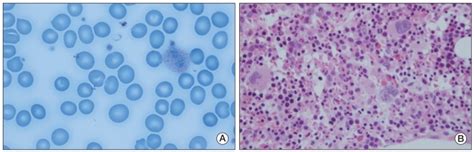 (A) Peripheral blood smear revealed macrocytic normochromic anemia (H&E ...