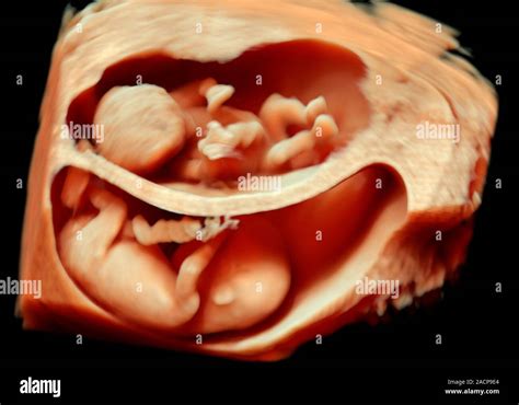 12 week foetus twins, 3-D ultrasound scan. Three-dimensional (3-D) ultrasound scan of a human ...