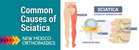 Common Causes of Sciatica - New Mexico Orthopaedic Associates