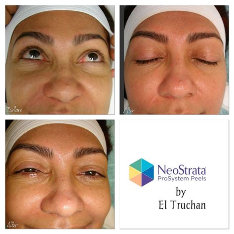 NeoStrata Chemical Peel - BEFORE & AFTER | Chemical peel, Permanent makeup, Permanent makeup ...