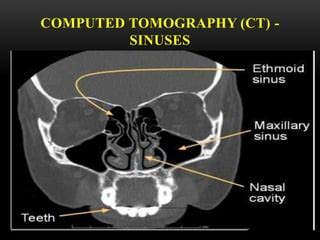 Ct pns | PPT