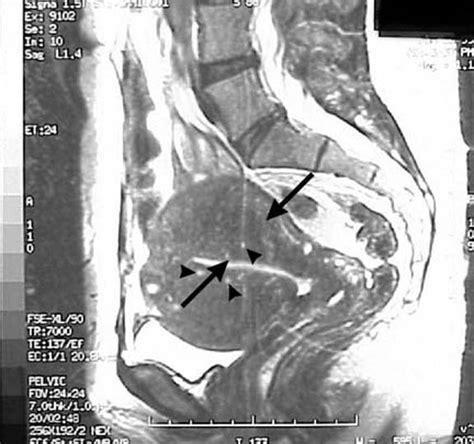 adenomyosis_mri.jpg [Nick's Radiology Wiki]