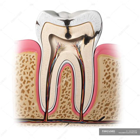 Pathology of Tooth decay — cross section, Front View - Stock Photo ...