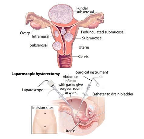 Laparoscopic Morcellation - FV Hospital