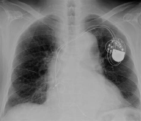 Preoperative chest X-ray. | Download Scientific Diagram