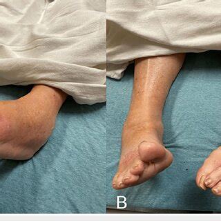 Lower extremity physical findings showing left ankle swelling and a ...