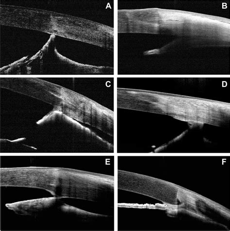 Types of anterior synechiae following penetrating keratoplasty in cases... | Download Scientific ...