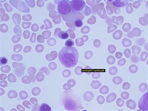 Neutrophilic Myelocyte - 3 | ERA