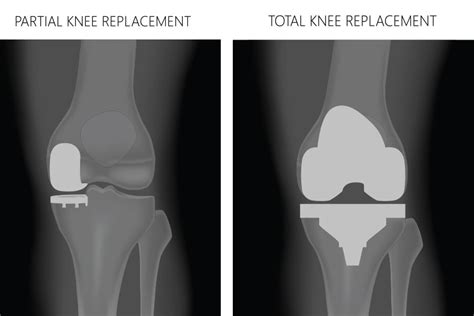 Partial knee replacement vs. total knee replacement