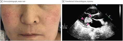 A Woman With Recurrent Syncope and Malar Flush in the Setting of a Left ...