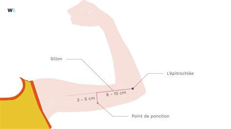 Comment poser un implant contraceptif à une patiente