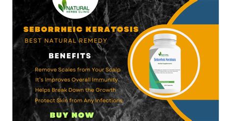 best home treatment for seborrheic keratosis Archives - Natural Herbs ...